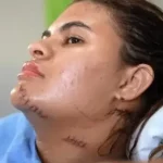 Sintomas silenciosos do câncer de ovário podem atrasar diagnóstico